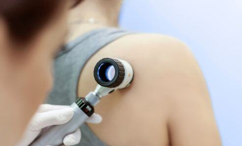 ¿Cómo comienza el Cáncer de Piel? [Primeros síntomas y cómo se ve]