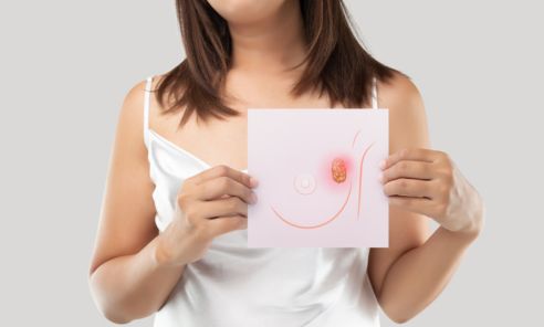 ¿Cómo saber que algo anda mal con mis senos? [SÍNTOMAS de cáncer de mama y cuándo ir al médico]