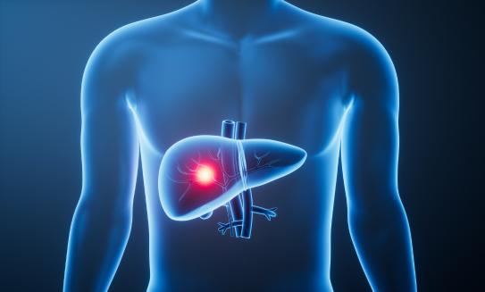 Cáncer de hígado: síntomas, factores de riesgo, diagnóstico y tratamiento