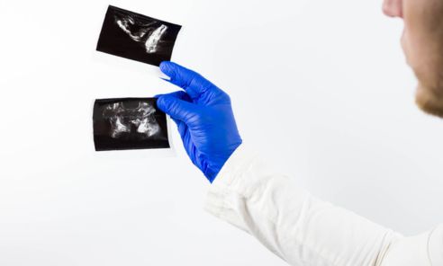 ¿Cómo entender los resultados de una biopsia de próstata?