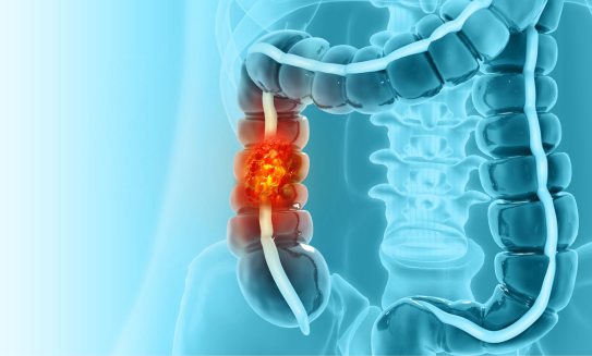 Cáncer de colon: síntomas, factores de riesgo, prevención y tratamientos