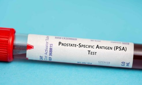 ¿Qué es el antígeno prostático y cómo se mide?
