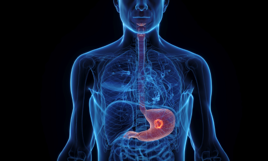 Cáncer de estómago: síntomas, causas, diagnóstico y tratamientos
